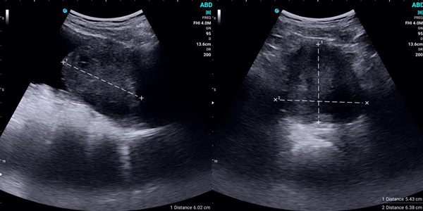 handheld ultrasound device