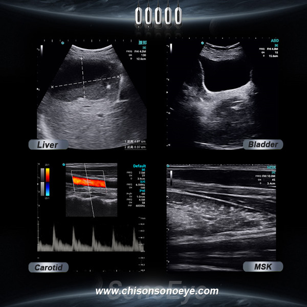 handheld ultrasound device