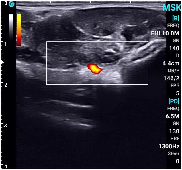 SonoEye Handheld Ultrasound in Plastic Surgery