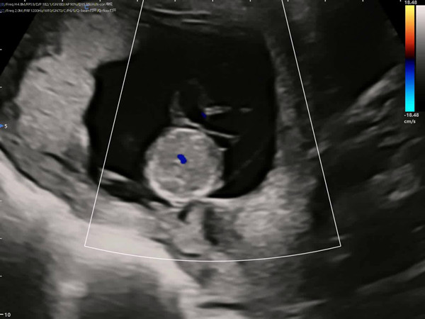 Ultrasound Diagnosis Of Fetal Umbilical Cord Cysts