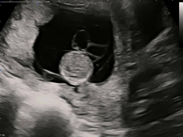 Ultrasound Diagnosis Of Fetal Umbilical Cord Cysts