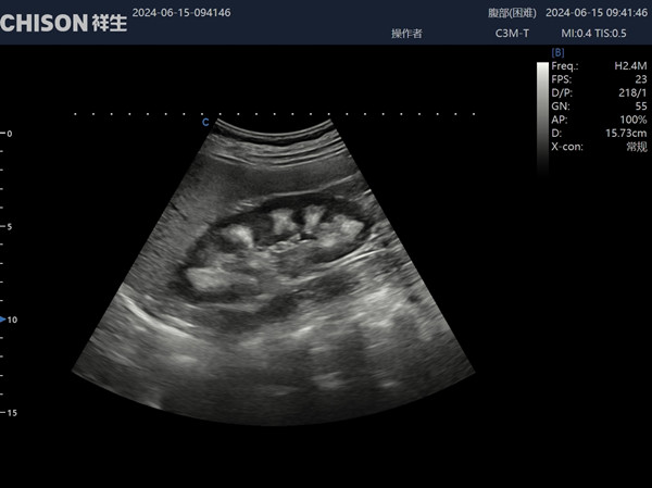 Ultrasound Diagnosis of Medullary Sponge Kidneys