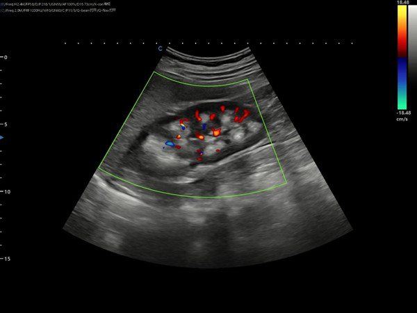 Ultrasound Diagnosis of Medullary Sponge Kidneys