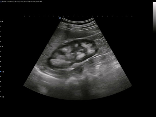 Ultrasound Diagnosis of Medullary Sponge Kidneys