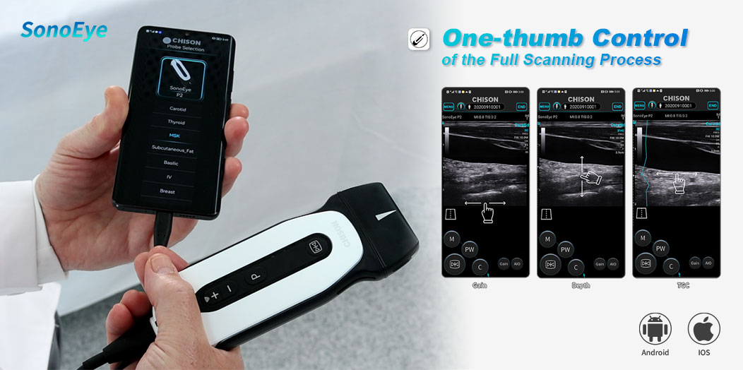 Study Confirms SonoEye as Top-Rated Handheld Ultrasound Device