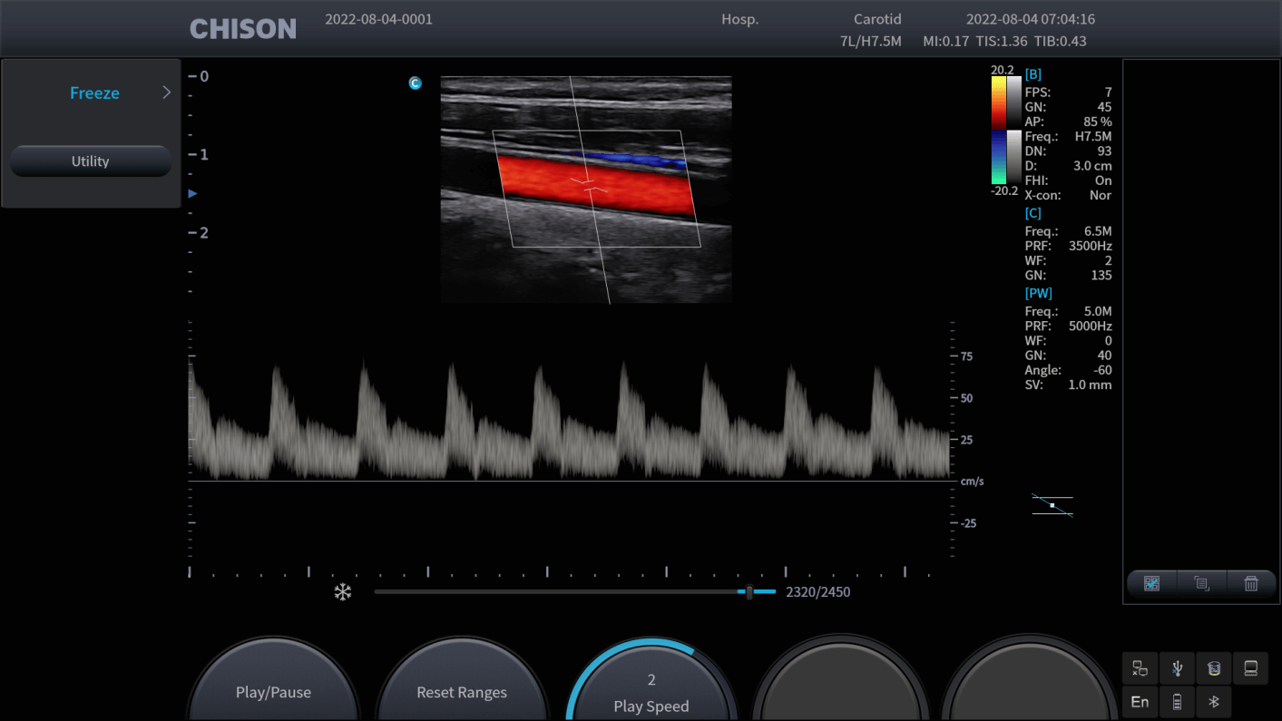 Breaking News! CHISON SonoAir Shown in BBC Report!