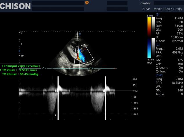 The Vital Role of Ultrasound in Cardiovascular Care: Early Detection Saves Lives