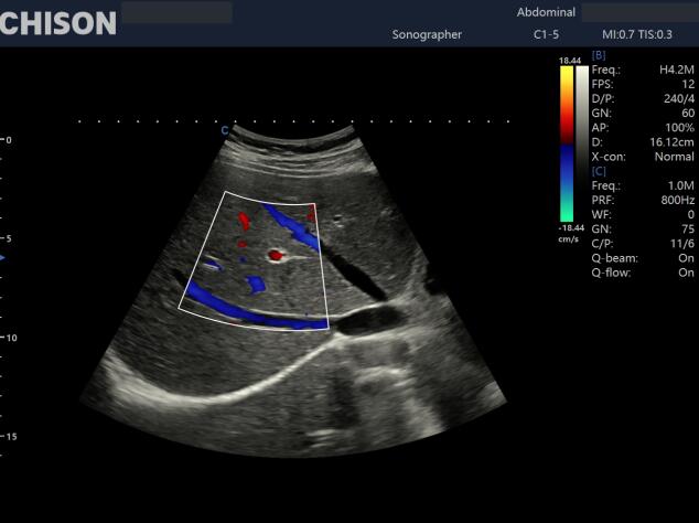 The Vital Role of Ultrasound in Cardiovascular Care: Early Detection Saves Lives