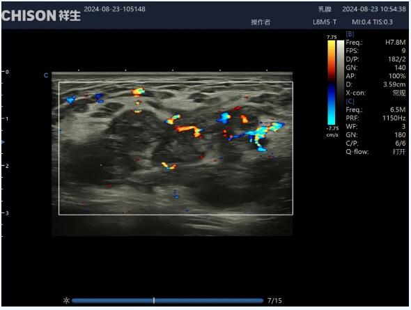 Ultrasound Diagnosis Of Granulomatous Mastitis