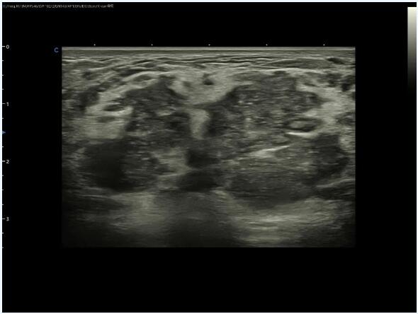 Ultrasound Diagnosis Of Granulomatous Mastitis