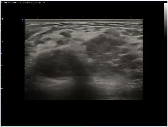 Ultrasound Diagnosis Of Granulomatous Mastitis