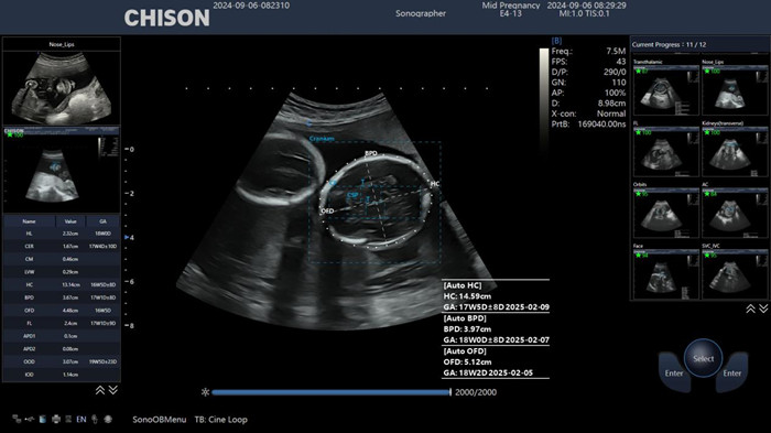 How Does Ultrasound Work?cid=4