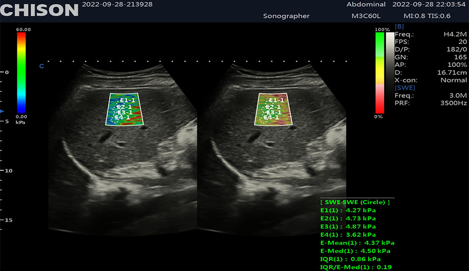 Shear Wave Elastography In Ultrasound: A Breakthrough In Diagnostic Imaging